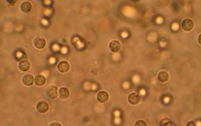 Urinary Tract Infection in Children